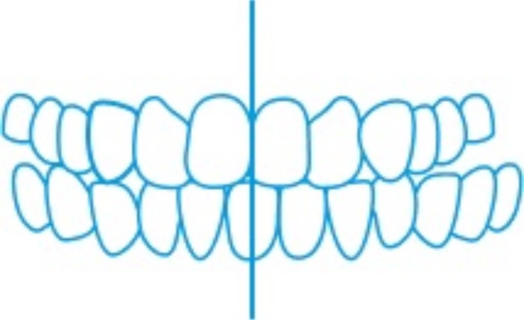 Crossbite
