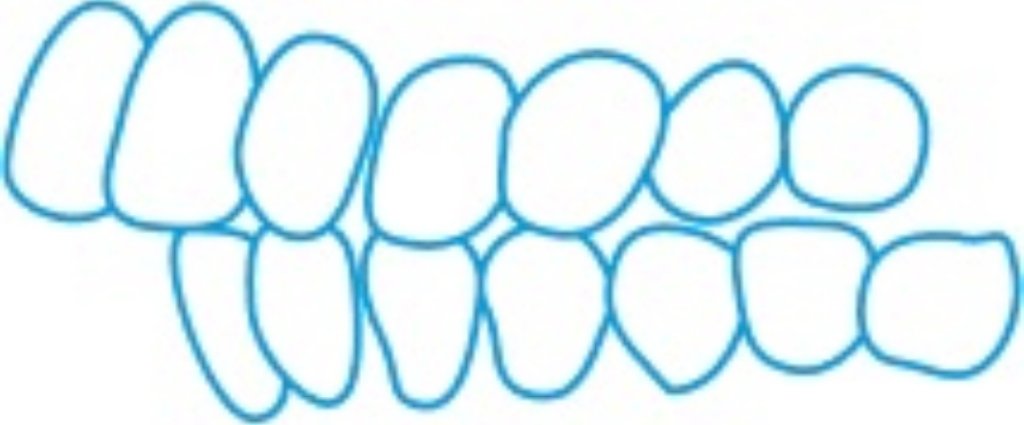Overbite