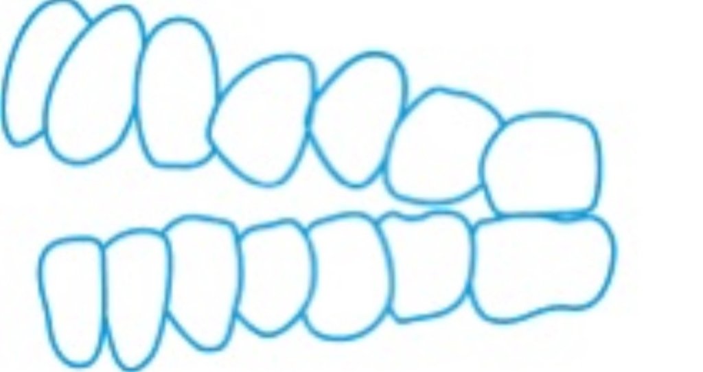 Openbite