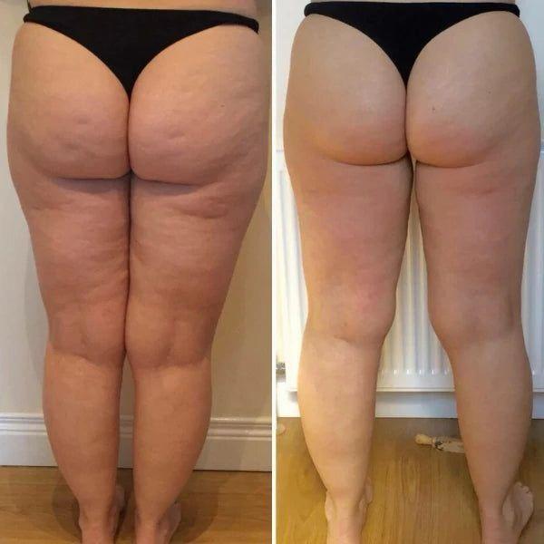 Antes y después - Piernas · Maderoterapia corporal