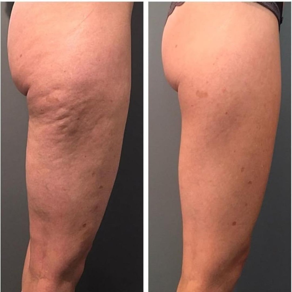 Antes y después - Celulitis · Maderoterapia corporal