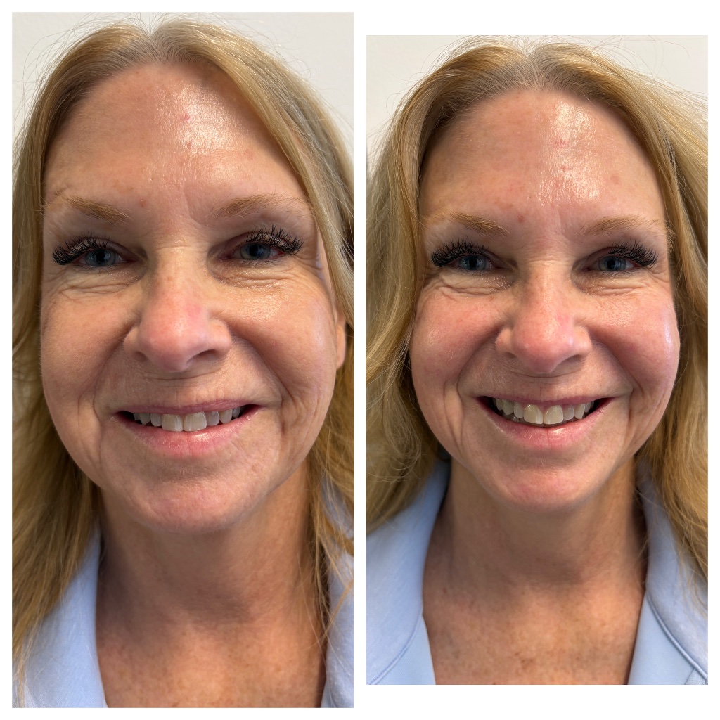 XERF before and after — crow's feet and nasolabial folds