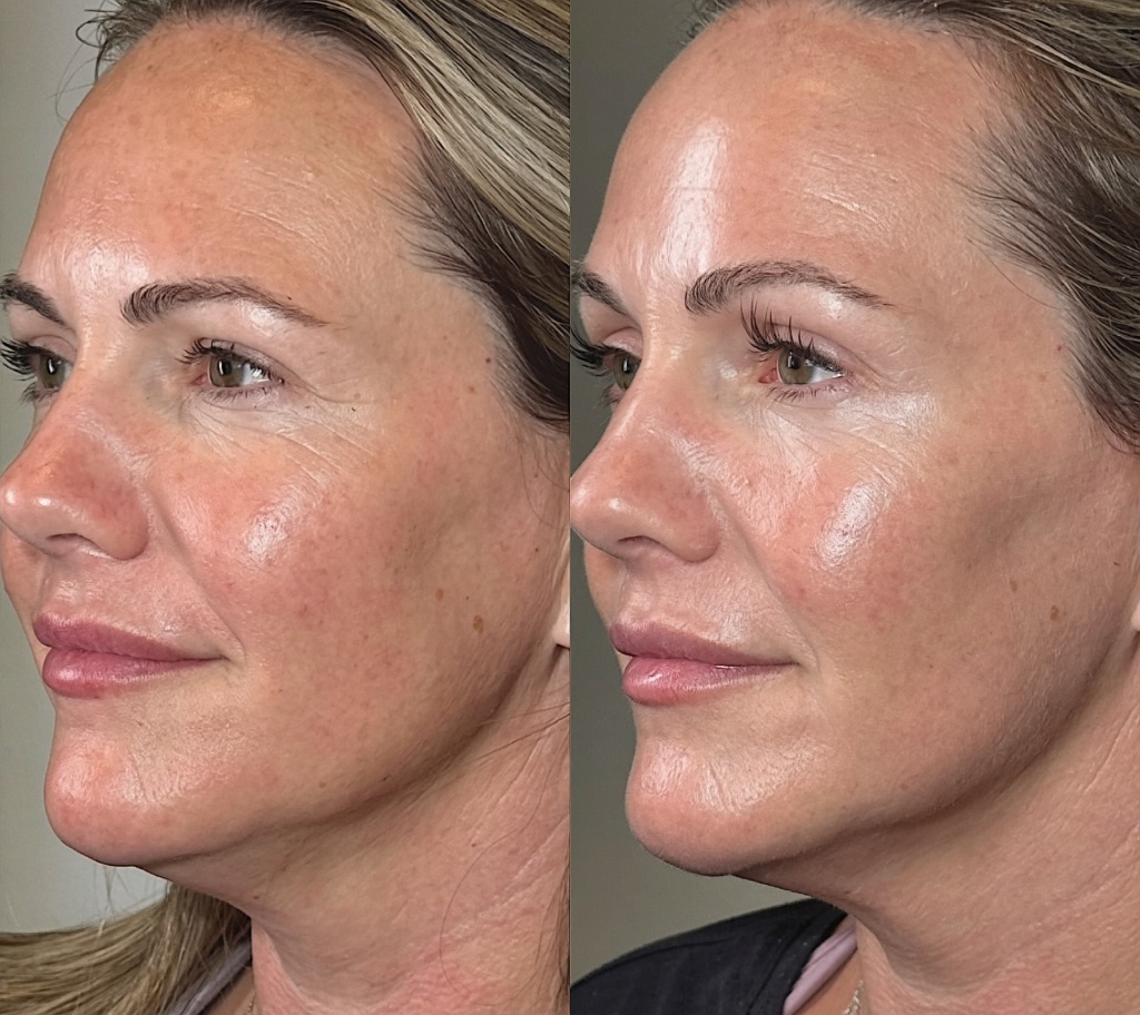 XERF before and after — crow's feet and skin firmness