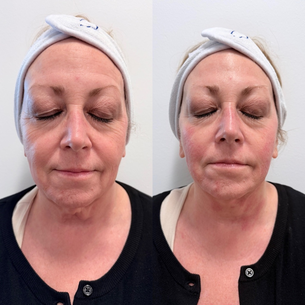 XERF before and after — skin texture and fine lines