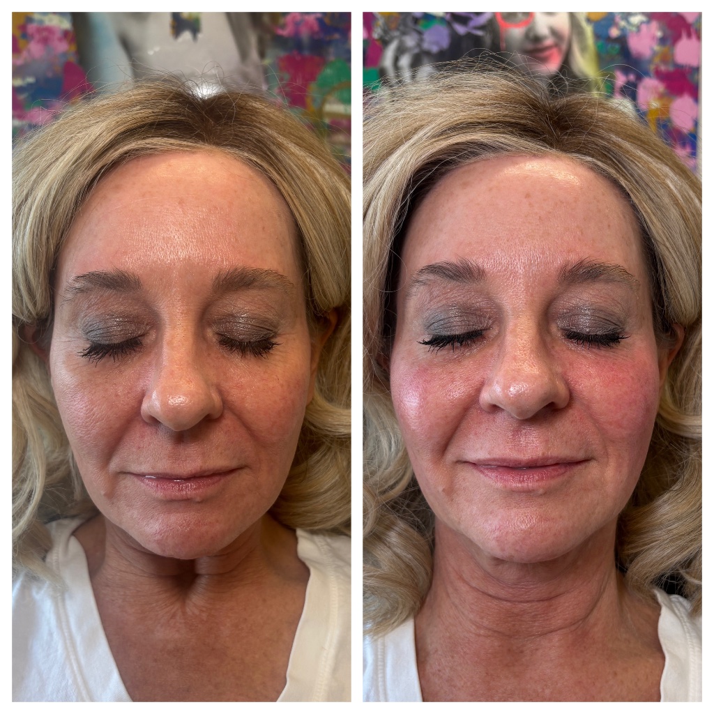 XERF before and after — mid-face and jawline firmness