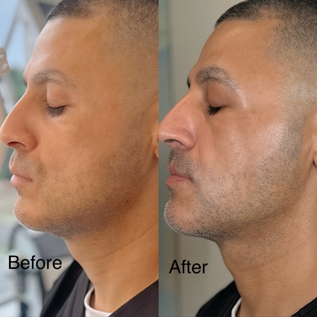 XERF before and after — male jawline definition