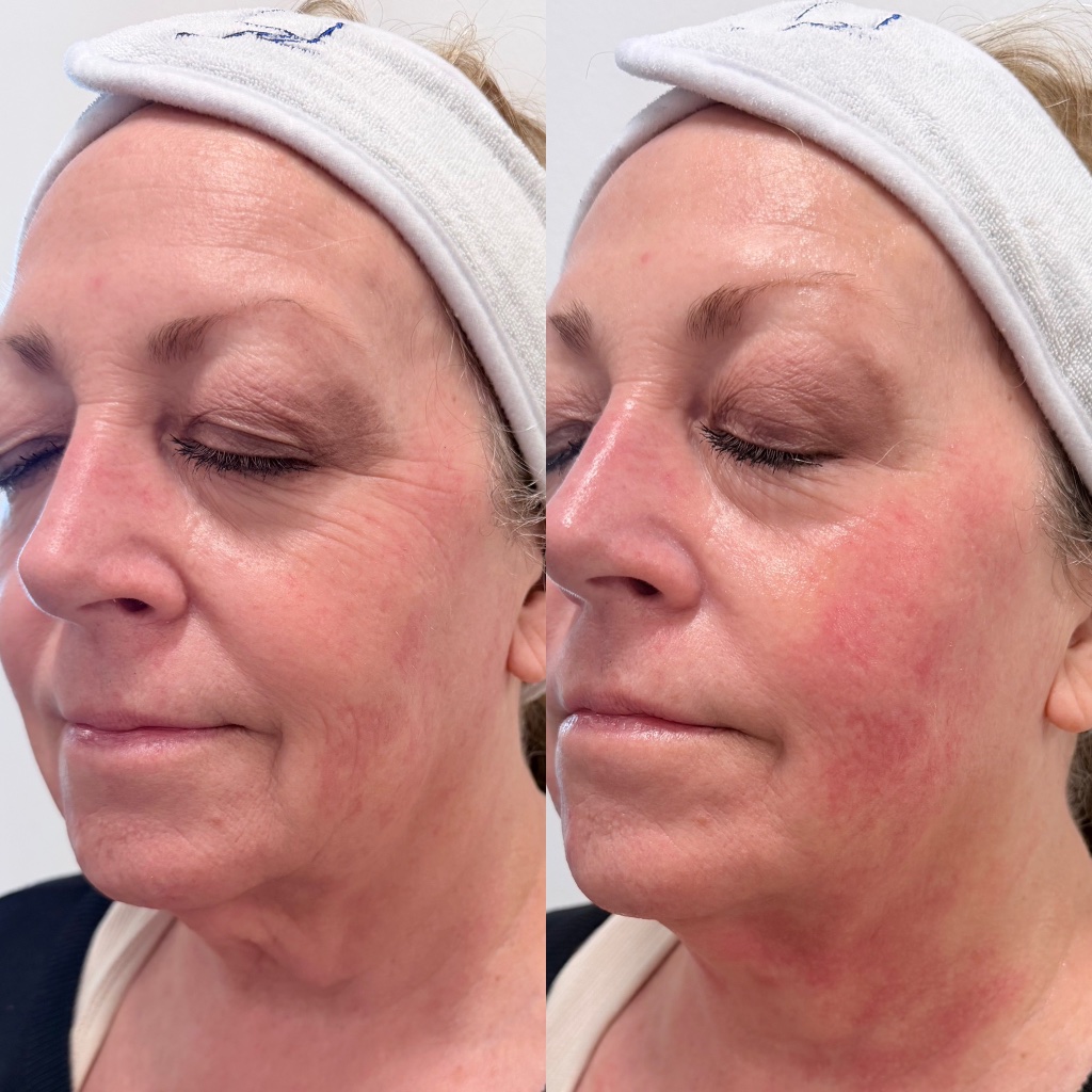 XERF before and after — jawline and mid-face tightening