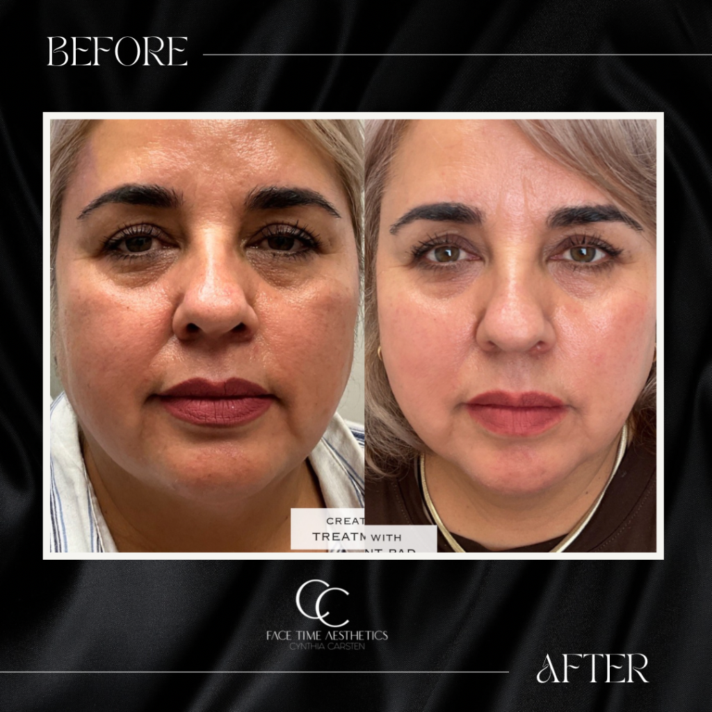 Before and after: Midface & Under-Eye Rejuvenation