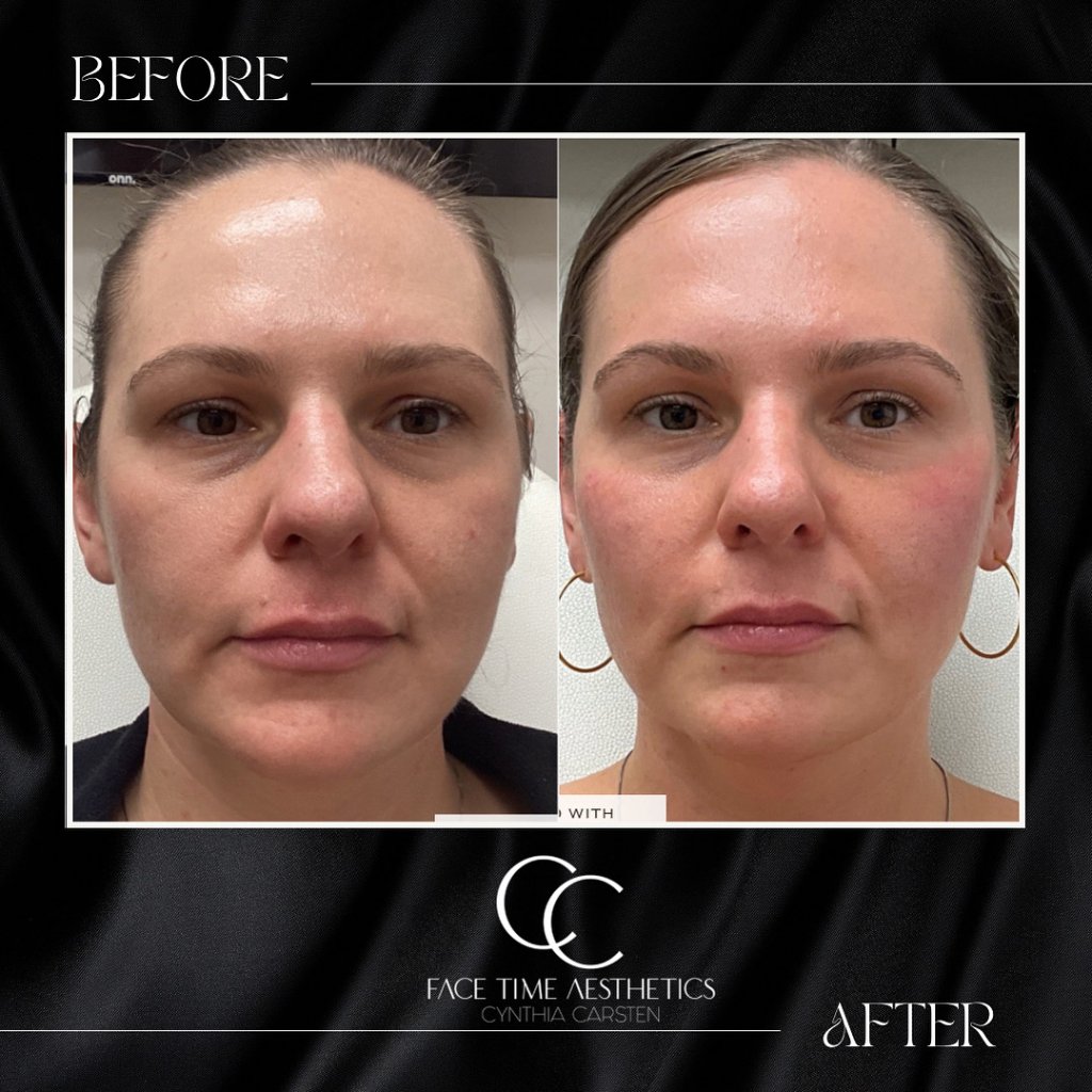 Before and after: Full-Face Volume Restoration