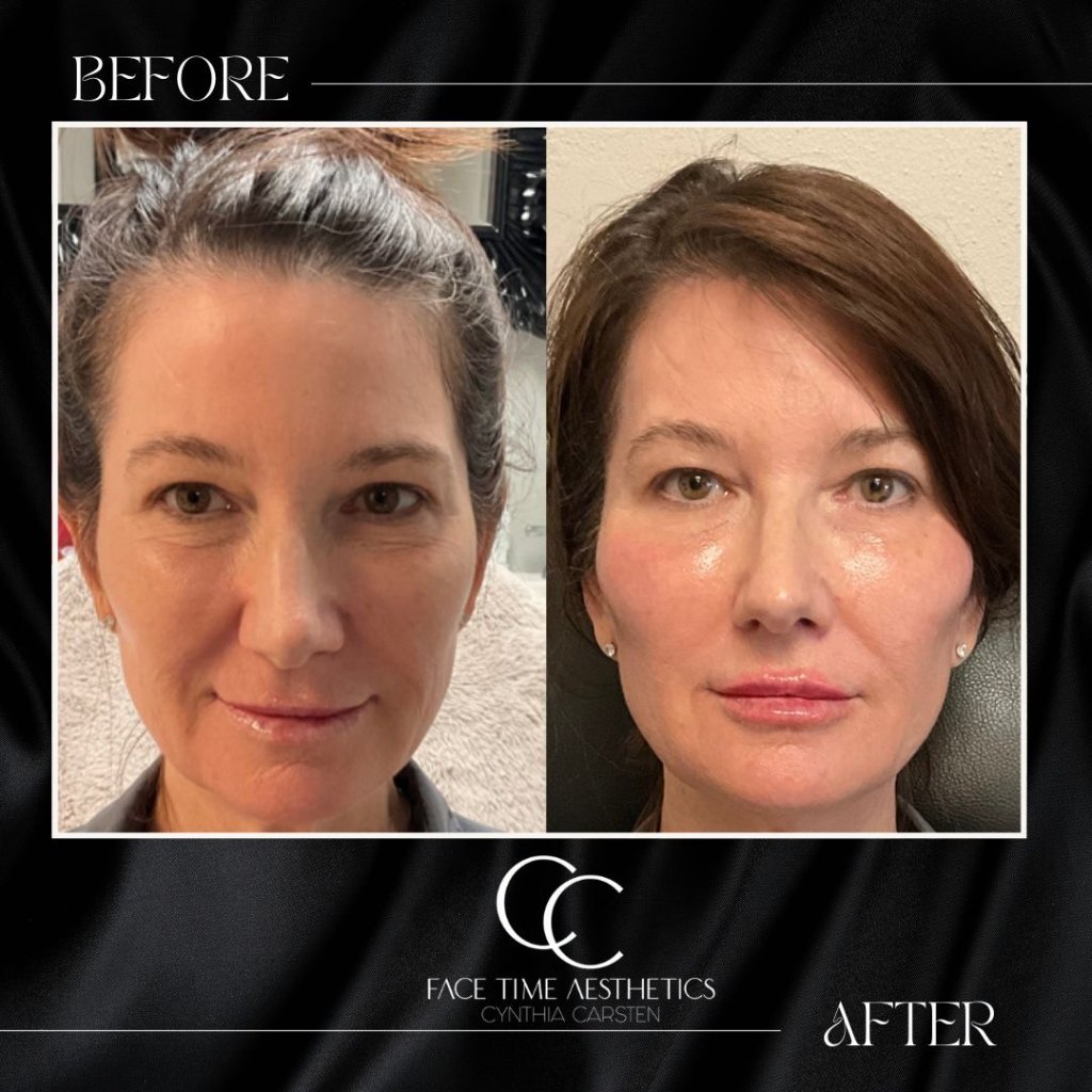 Before and after: Facial Harmonization