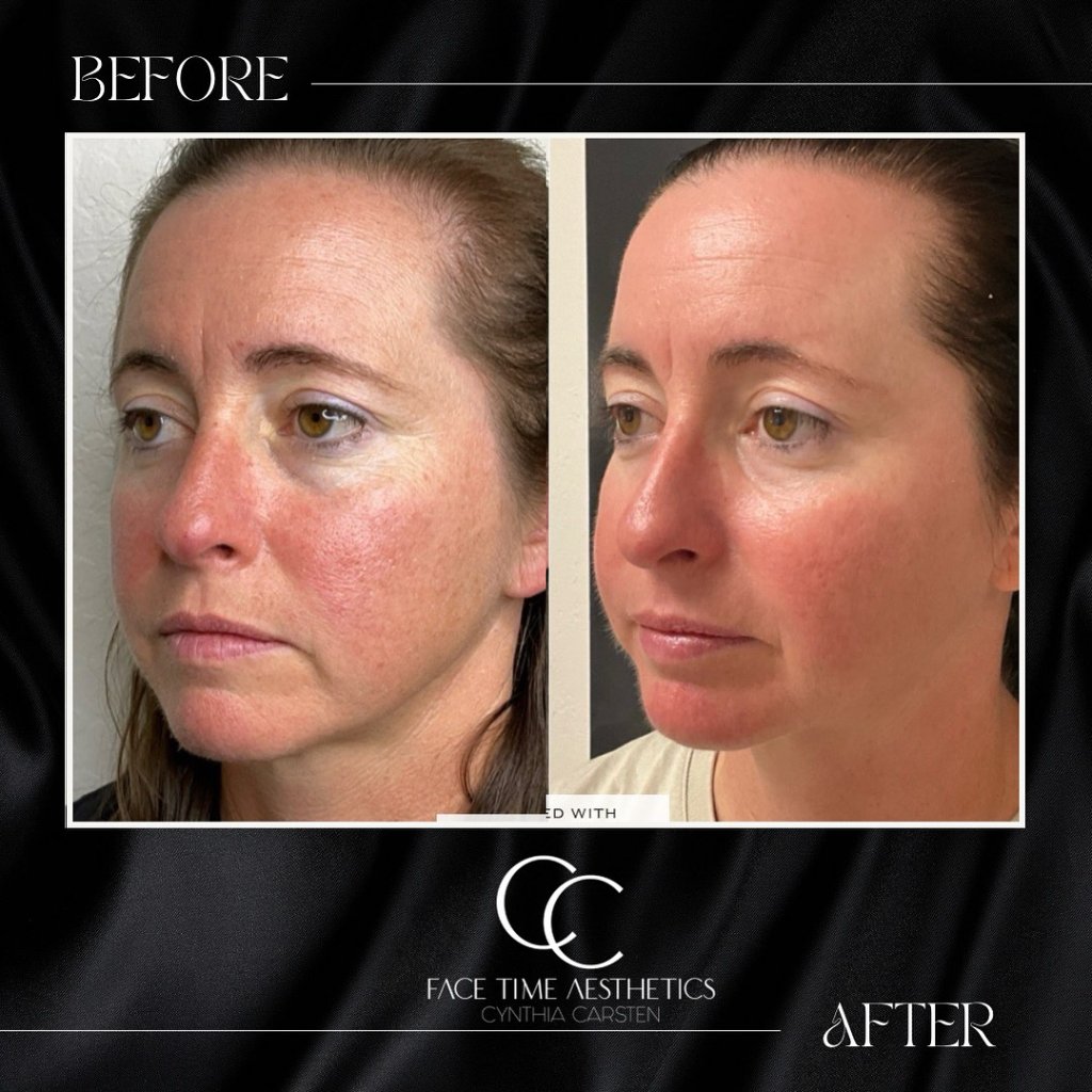 Before and after: Skin Texture & Tone Renewal