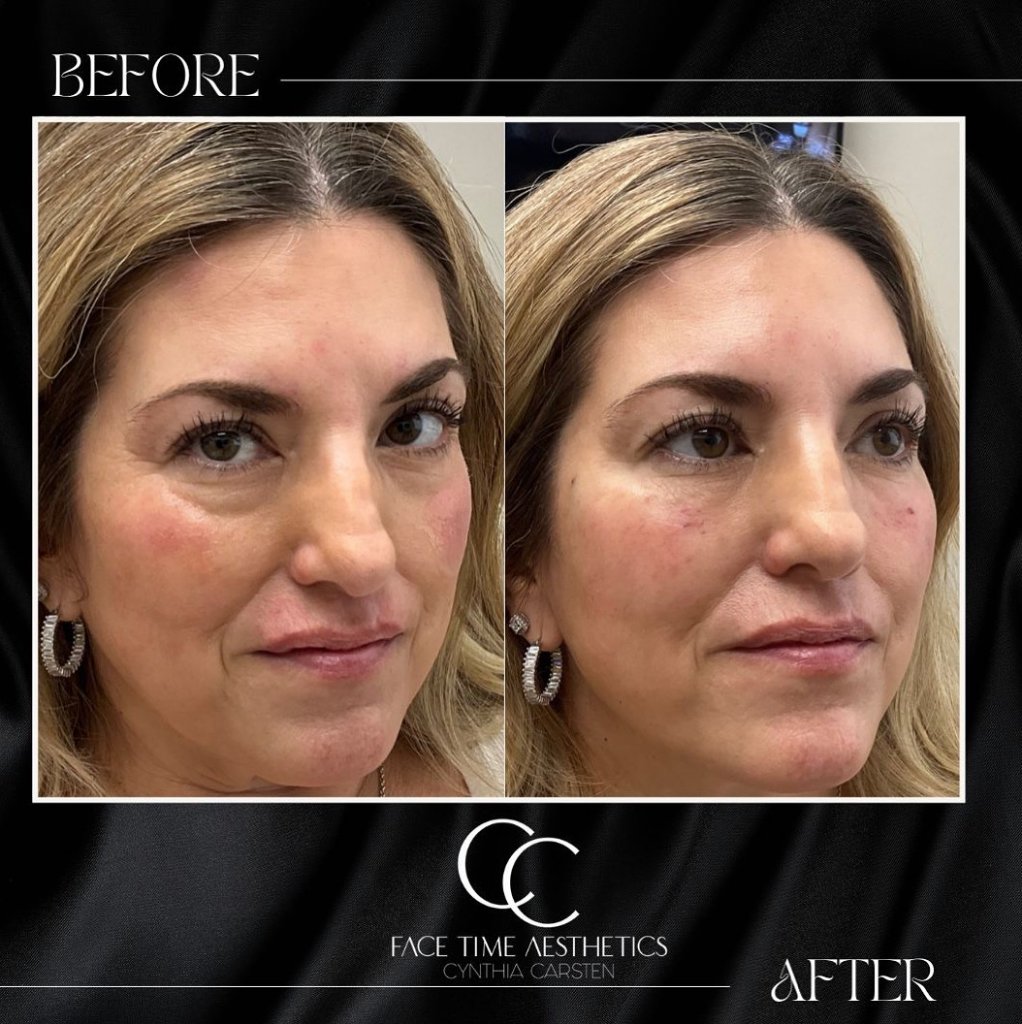Before and after: Cheek & Jawline Contouring