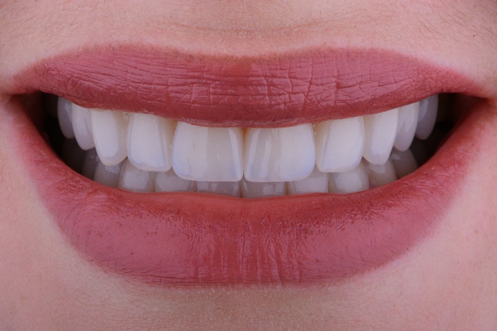 Digitalt smile design på skjerm