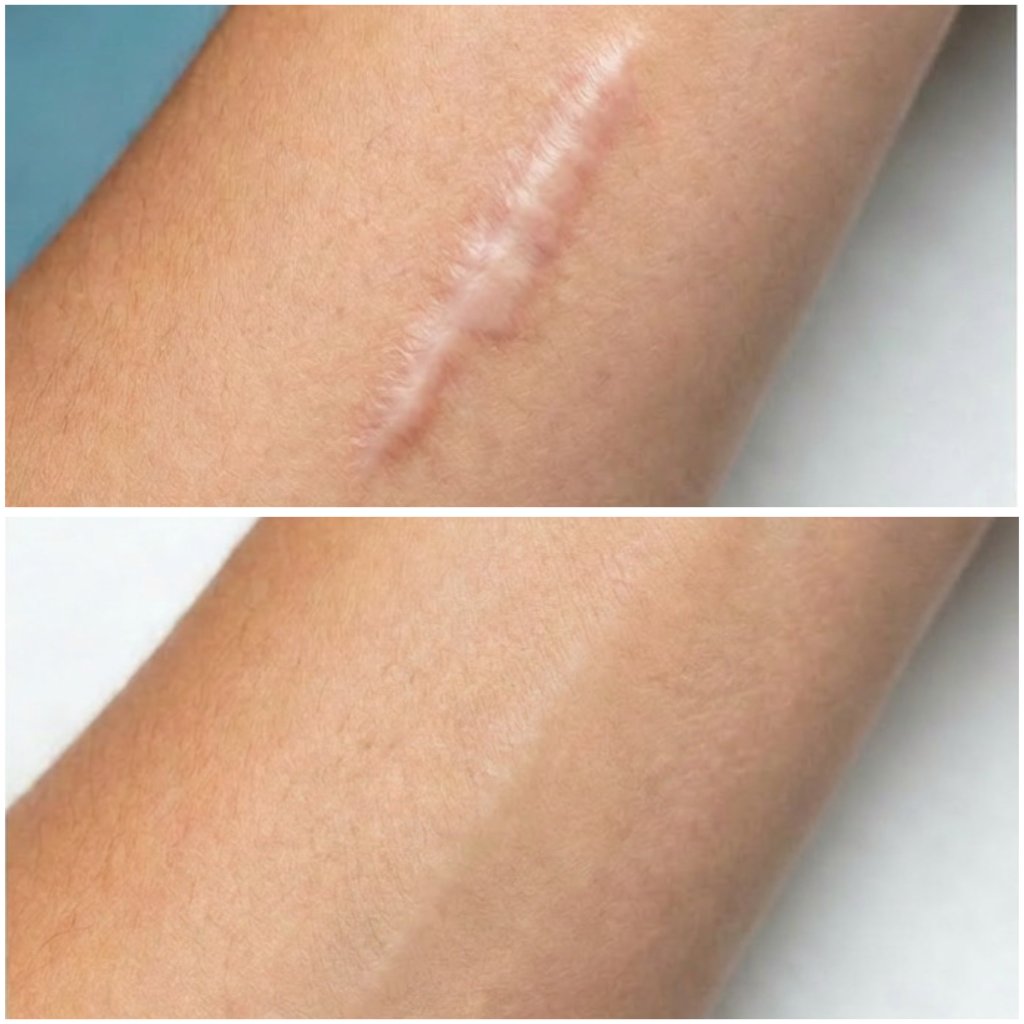 Tattoo Skin Camouflage