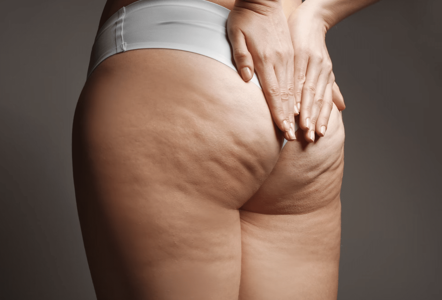 Cellulite Removal