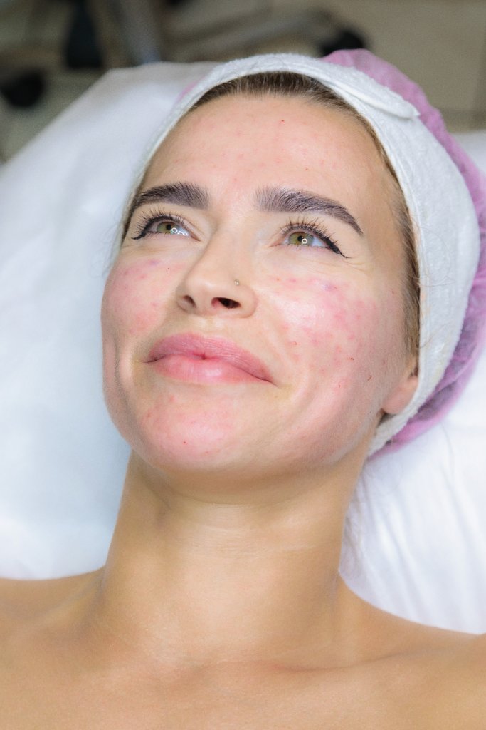 Oily and Acne-Prone Skin Peel