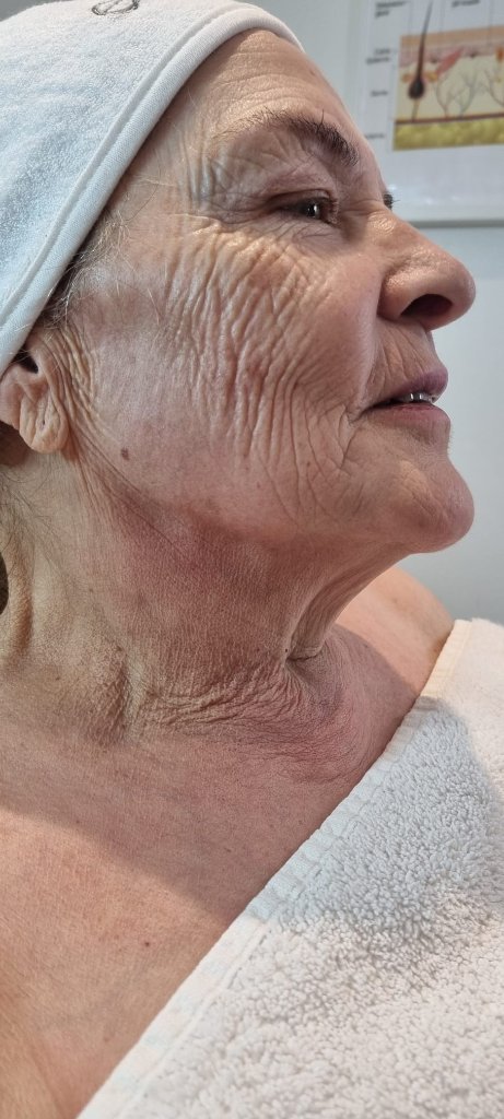Lola before Signature Glow Facial