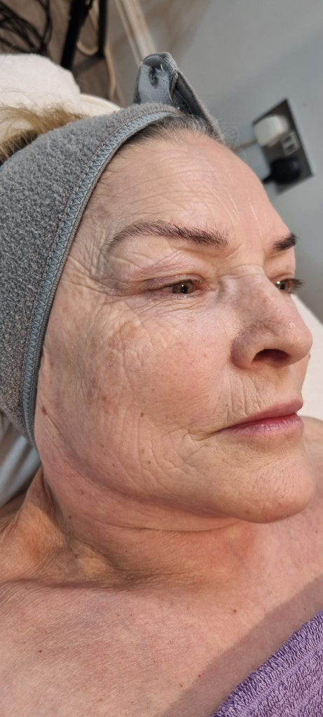 Lola after 3 sessions of Signature Glow Facial