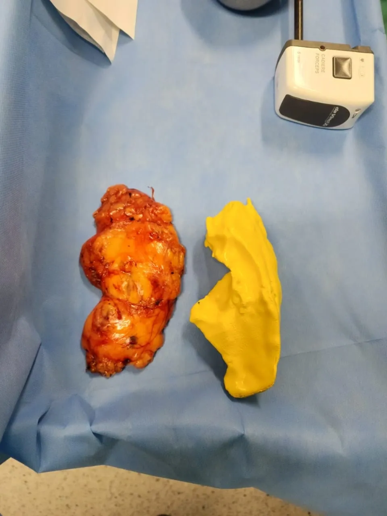 Comparativo Tumor vs. Biomodelo