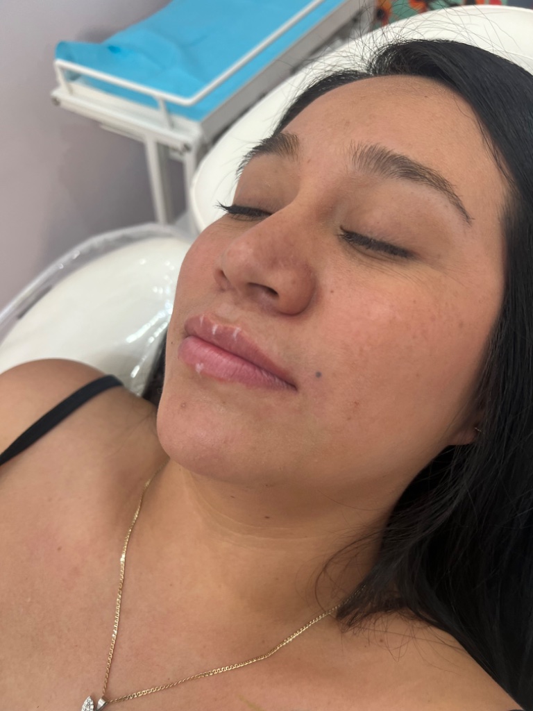 Before Dermal Filler — Volume Restoration treatment