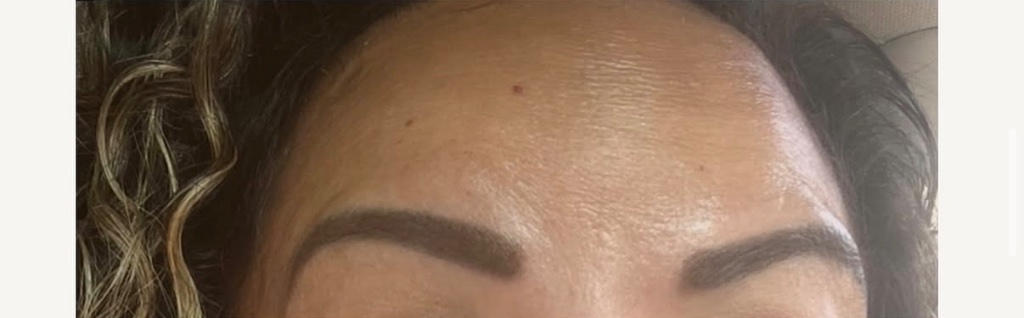 After Neuromodulators — Dynamic Wrinkle Correction treatment