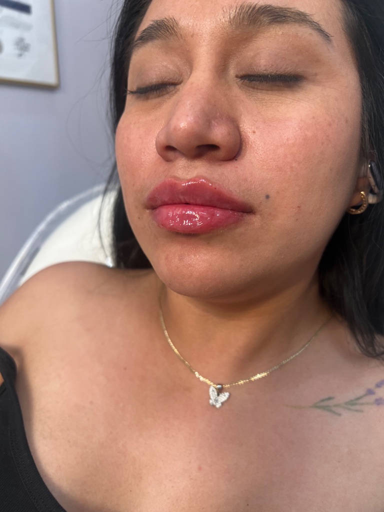 After Dermal Filler — Volume Restoration treatment