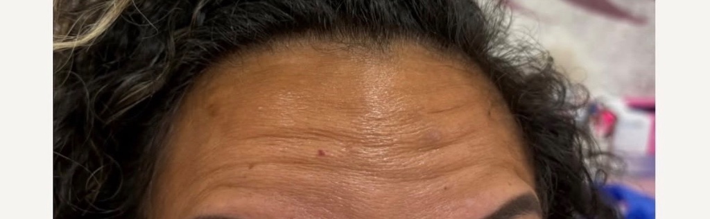 Before Neuromodulators — Dynamic Wrinkle Correction treatment