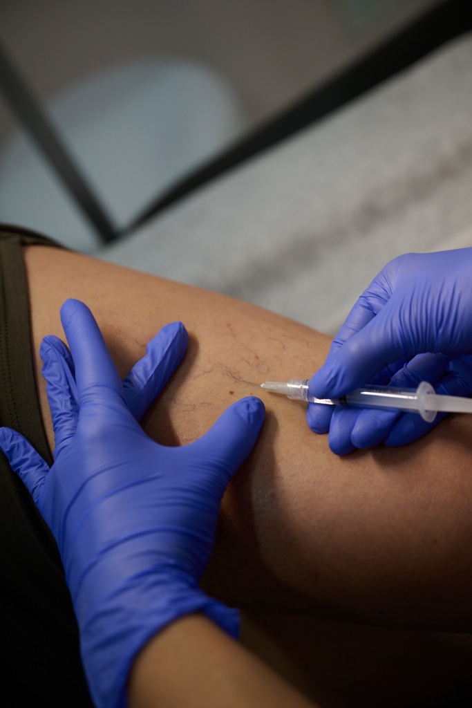 Sclerotherapy treatment