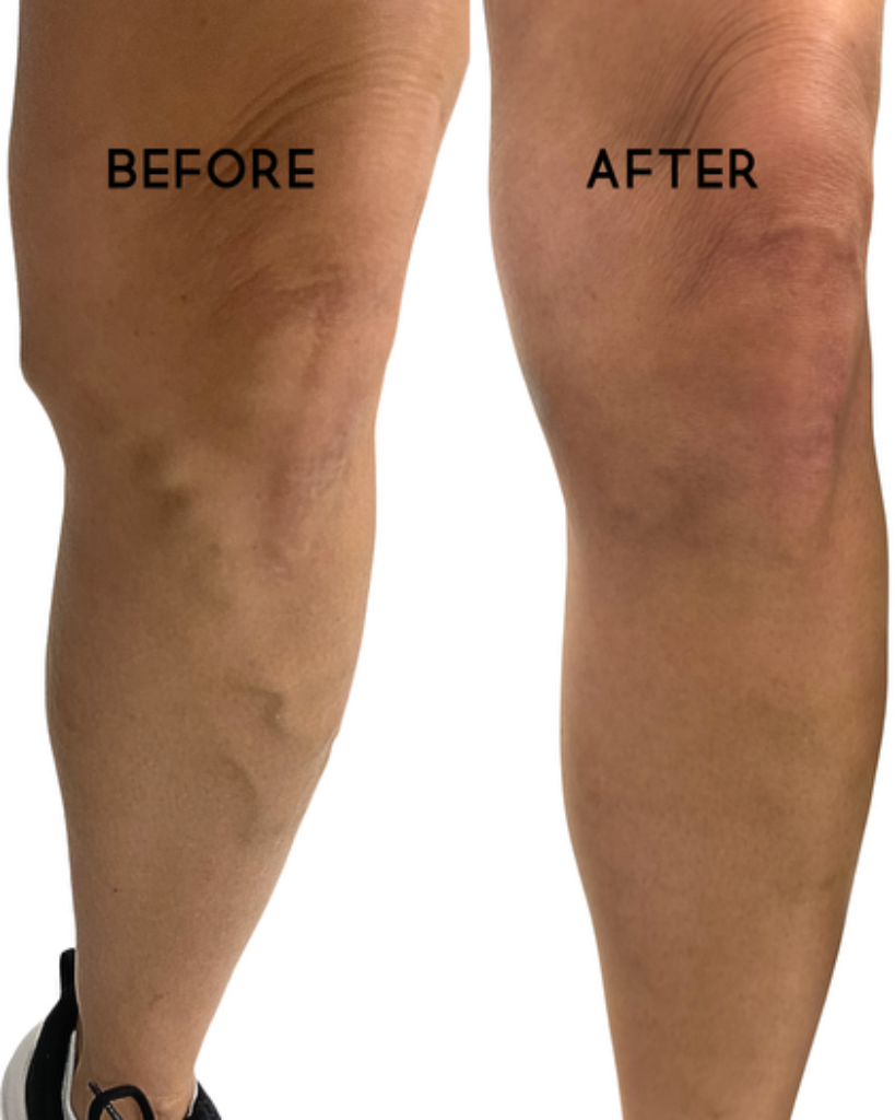 Sclerotherapy — Spider Vein Elimination treatment result