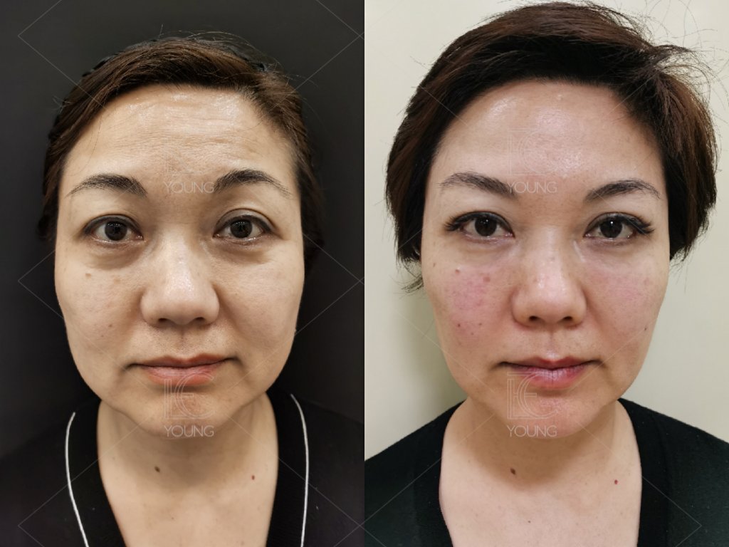 Anti-Wrinkle & Skin Rejuvenation before and after