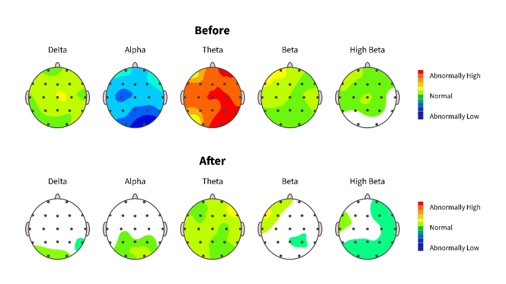 Brain map comparison before and after neurofeedback