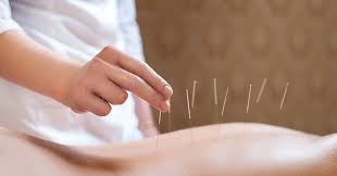 Acupuntura