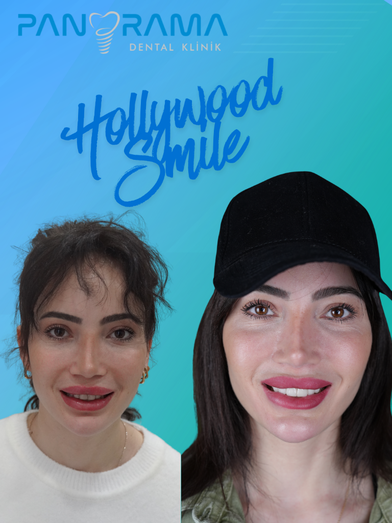 Hollywood Gülüşü