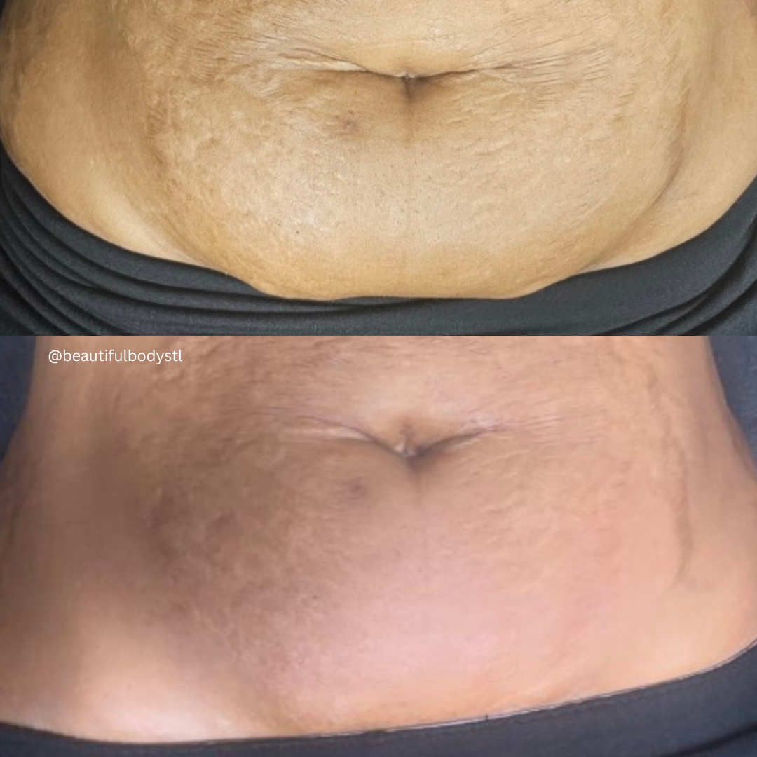 After 4 Targeted Fat Reduction sessions