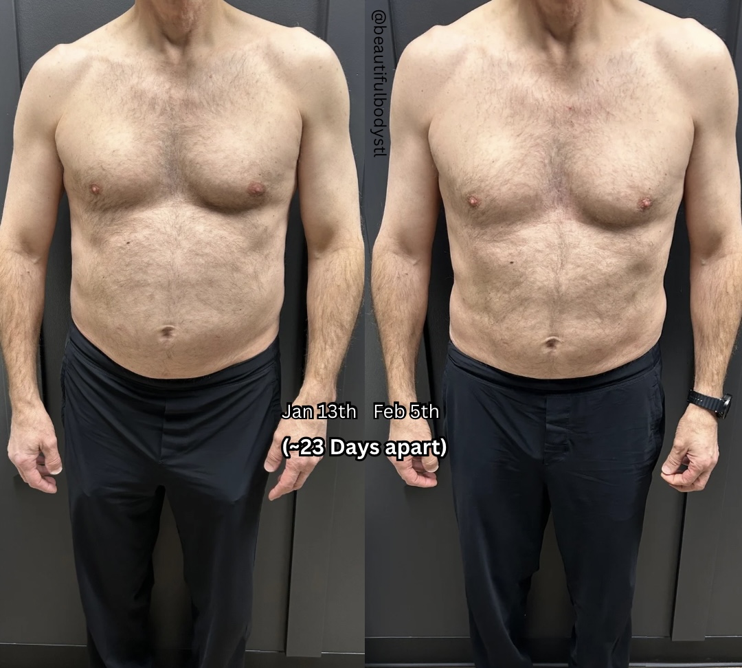 After 2 EMS Sculpt sessions