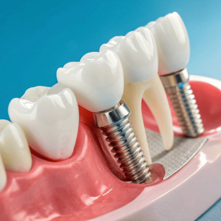 Single dental implant post with crown on blue background