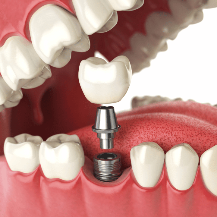 Dental implant crown being placed on abutment