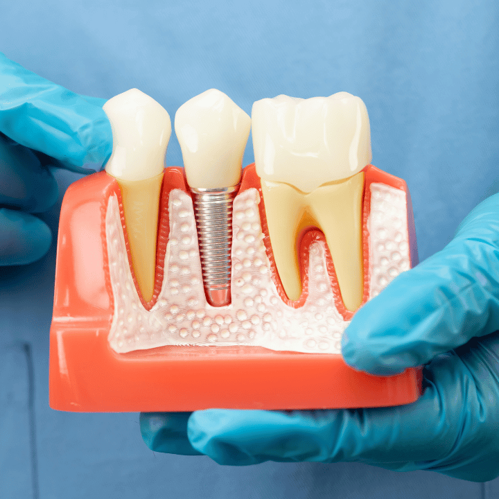 Cross-section dental implant model held by dentist