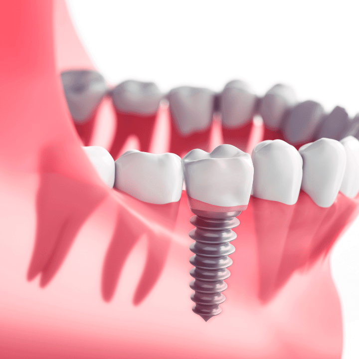 Single tooth implant screw in gum tissue model