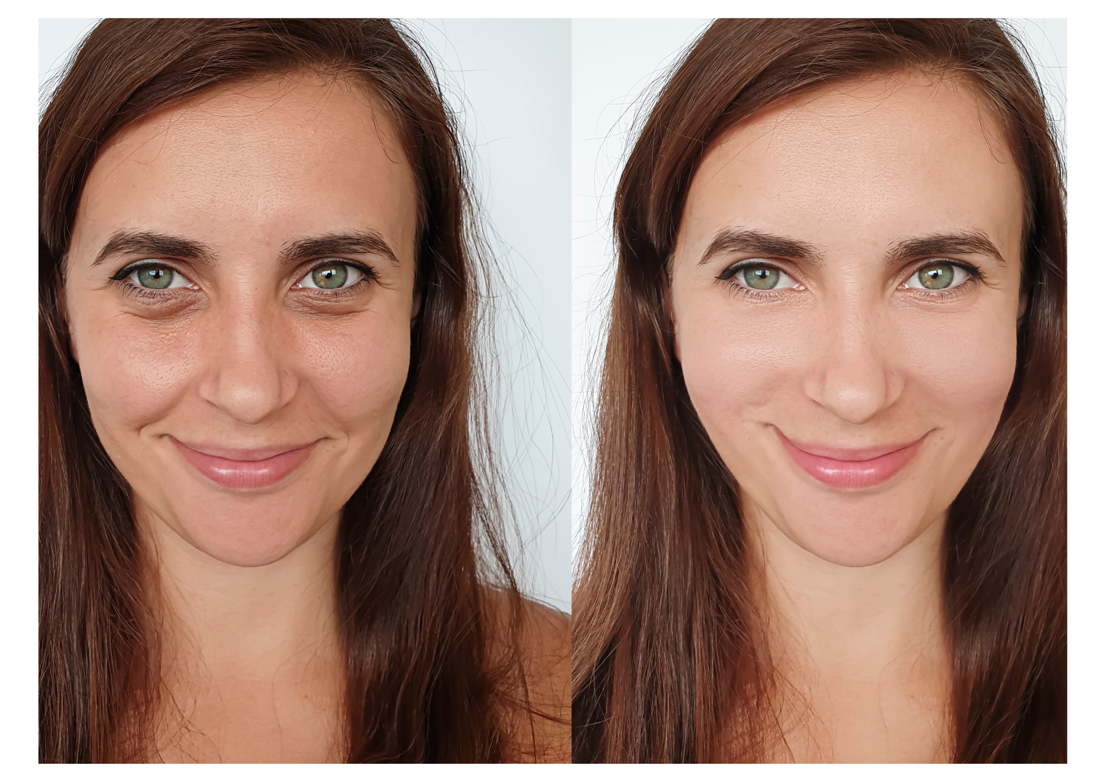 Under-eye polynucleotides treatment showing results