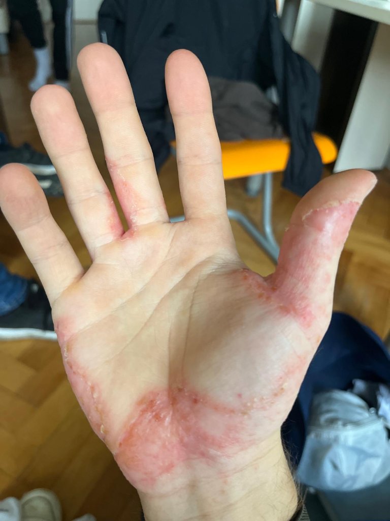 Hand mit Hautirritationen