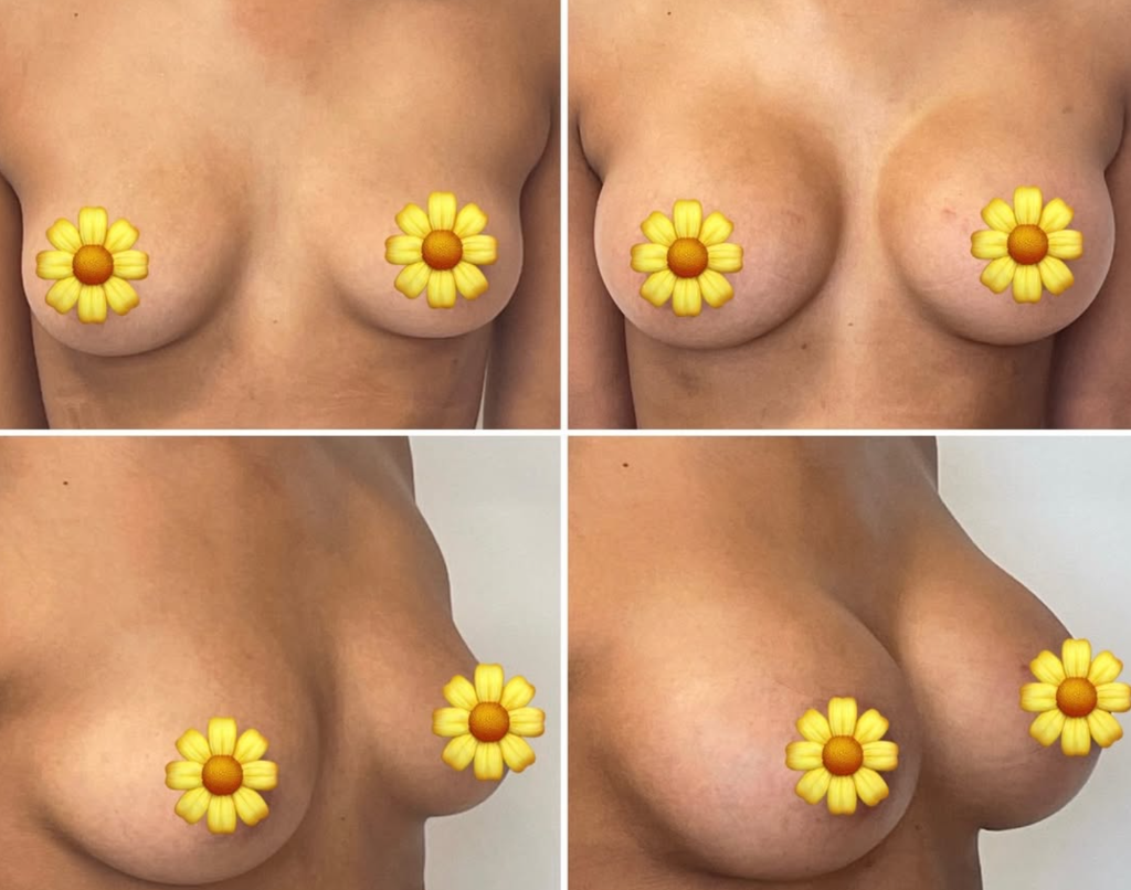 Breast