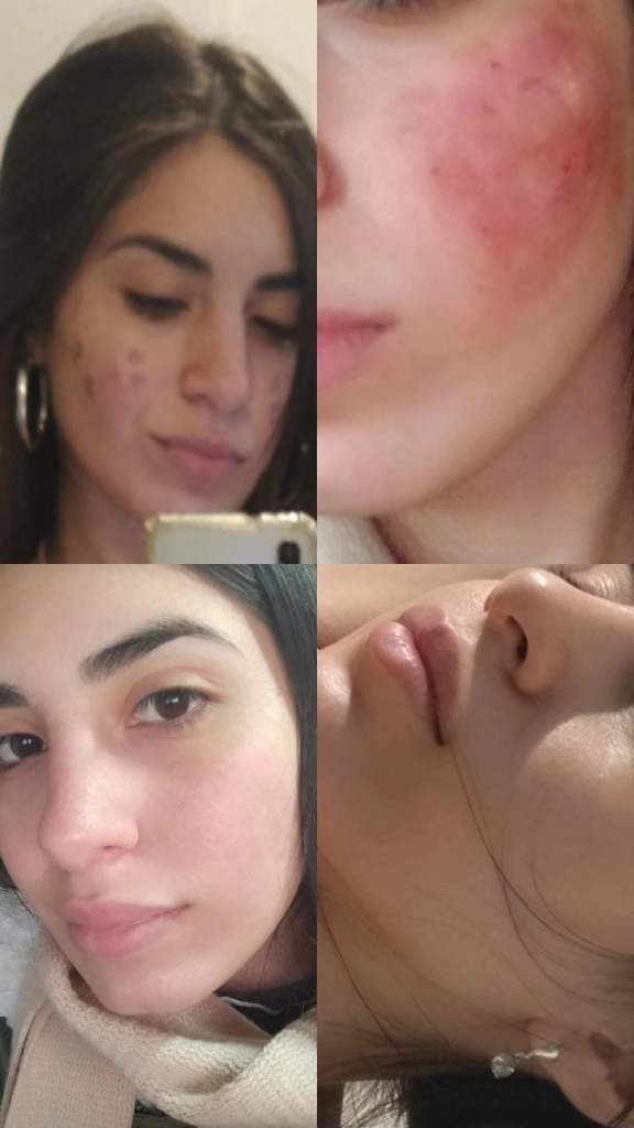 Antes y después — Renovación cutánea