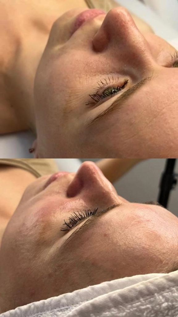 Antes y después — Tratamiento facial