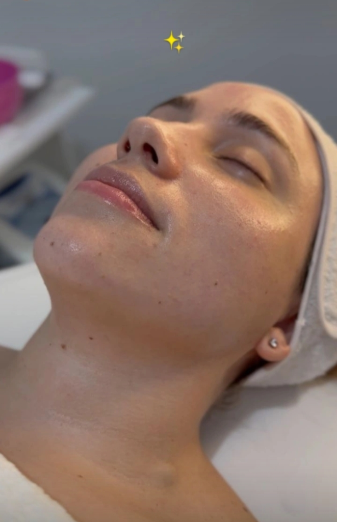 Peeling Químico