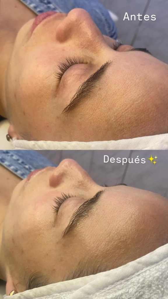 Antes y después — Limpieza facial profunda