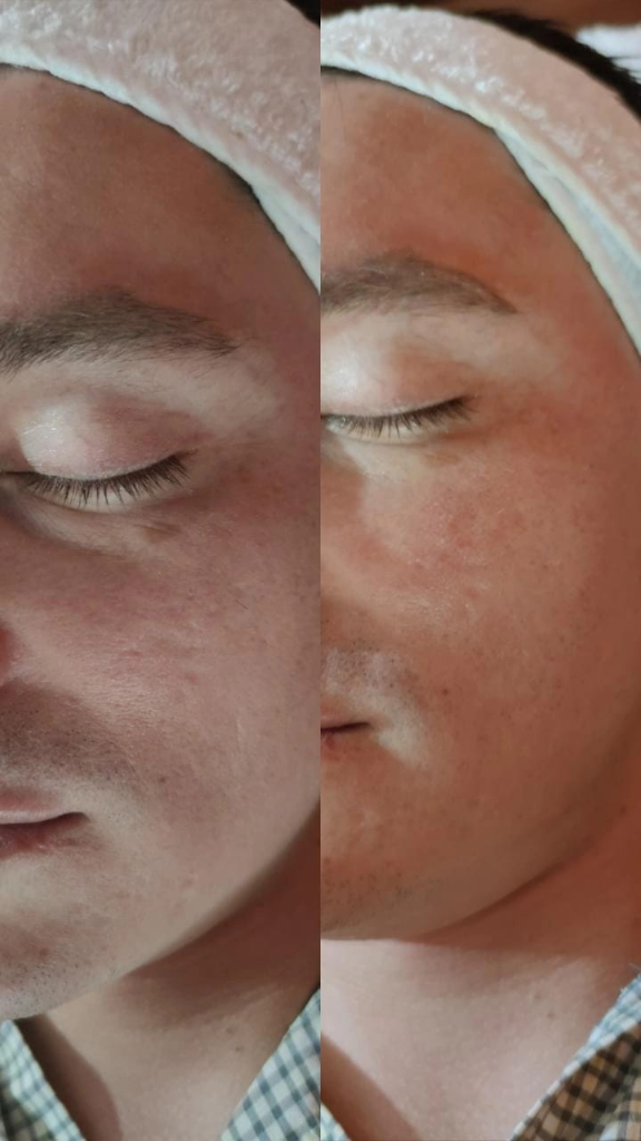 Antes y después — Piel con acné