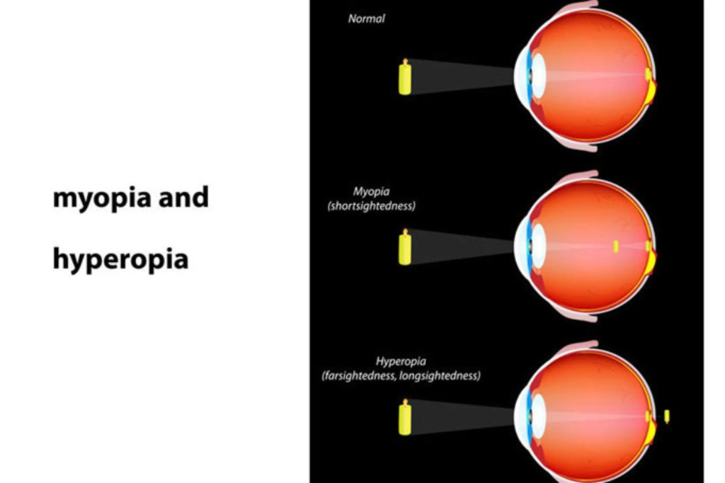 Refractive Errors