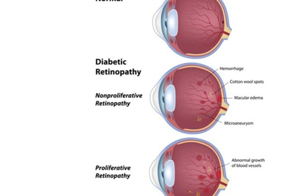 Diabetic Retinopathy