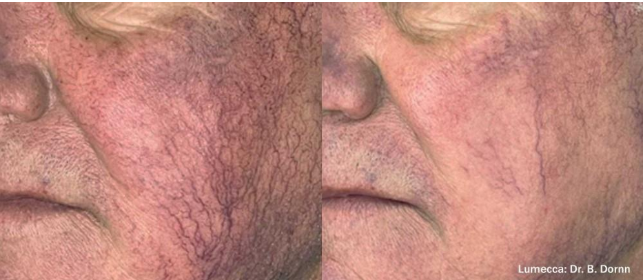 Before and after IPL treatment — redness reduction